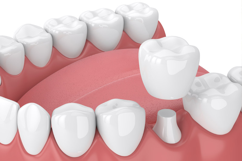 Dental Crowns in Fremont