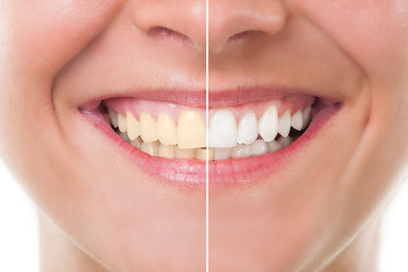 Teeth Whitening in Fremont